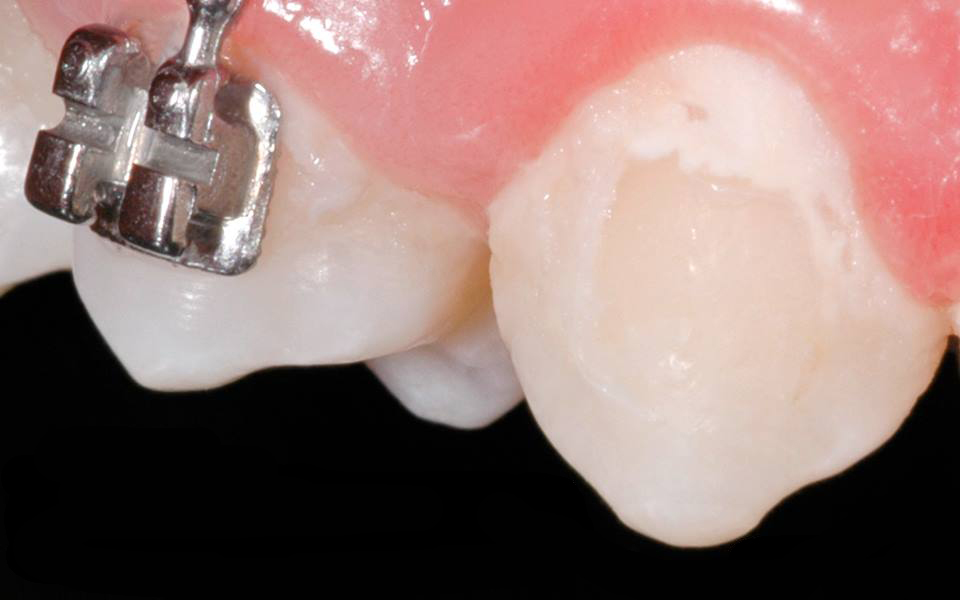Do stains remain on the teeth after braces?
